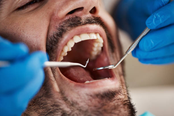 Best Emergency Dentist for Lost Fillings or Crowns in Middlebush, NJ